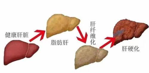 脂肪肝明星,揭秘明星健康危机与逆转之路